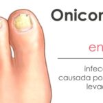 Onicomicosis