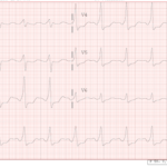 Electrocardiograma